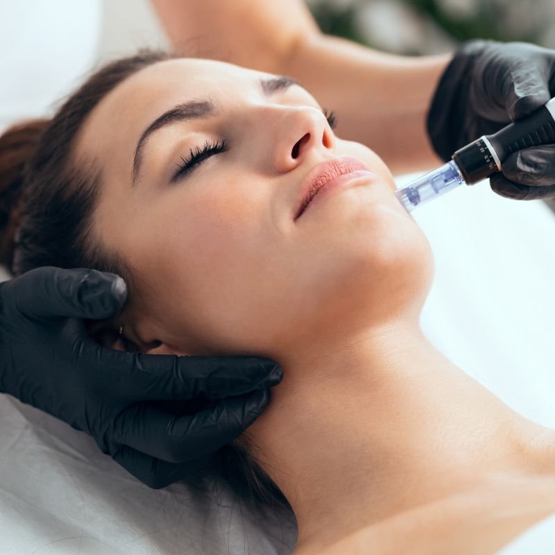 Microneedling